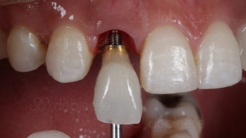 درمان بی دندانی قدامی با ایمپلنت و روکش های زیبایی IPS