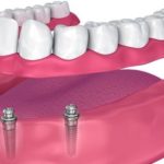 درمان بی دندانی کامل با ایمپلنت و overdenture