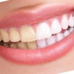 سفید کردن دندانها به روش (Bleaching)