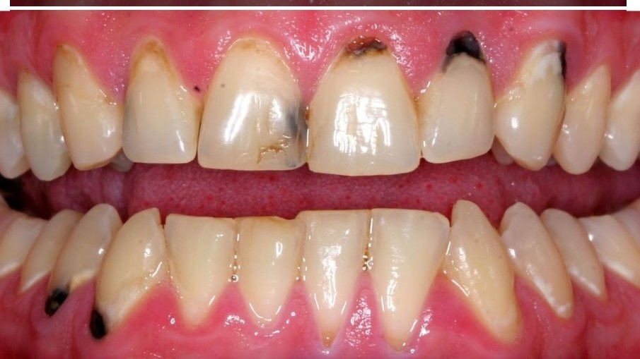 اصلاح بدشکلی و بدرنگی دندانها با لمینیت فول پرسلن IPS