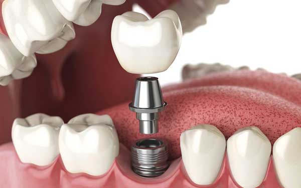 کاربرد ایمپلنت دندان در اصلاح طرح لبخند