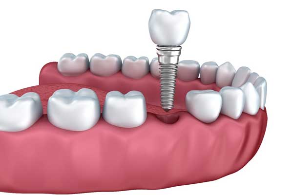 کاربرد ایمپلنت دندان در اصلاح طرح لبخند 