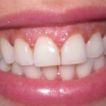 راه های پیشگیری و درمان تحلیل لثه
