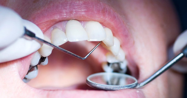آسیب مینای دندان و پیشگیری و درمان آن 