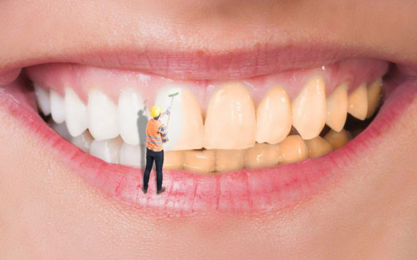 روش های سفید کردن دندان در مطب 
