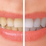 قیمت بلیچینگ دندان