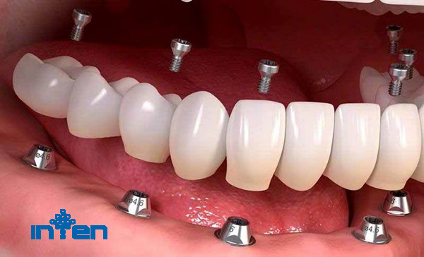 راه های نگهداری و مراقبت از ایمپلنت دندان
