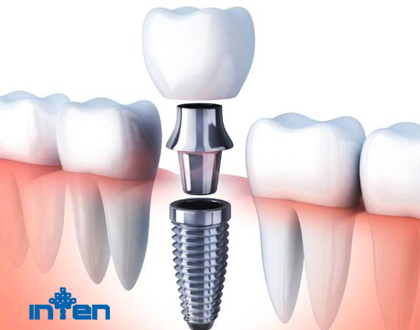 راه های نگهداری و مراقبت از ایمپلنت دندان 