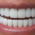 تفاوت کامپوزیت و لمینت سرامیکی دندان