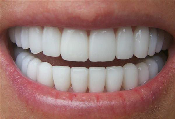 تفاوت کامپوزیت و لمینت سرامیکی دندان