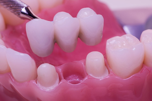 مزایا و معایب استفاده از روکش دندان ips 