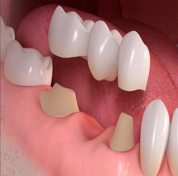مزایا و معایب استفاده از روکش دندان ips 