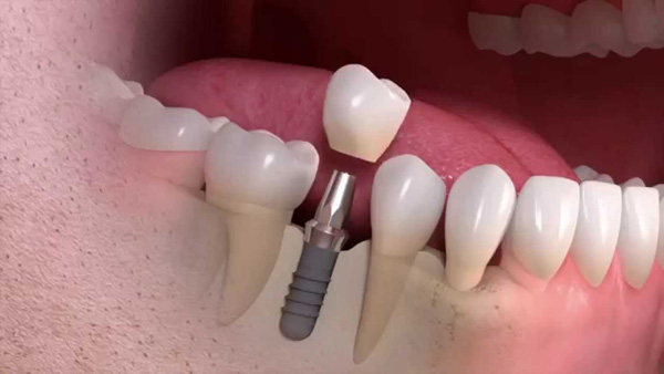 تفاوت کامپوزیت دندان و ایمپلنت 