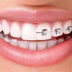 تفاوت لمینت دندان و ارتودنسی
