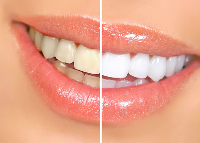 تفاوت انواع لمینت دندان