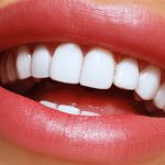 آیا لمینت دندان باعث پوسیدگی دندان ها می شود؟