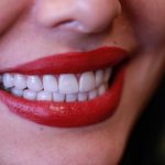 انجام لمینت دندان در سنین پایین