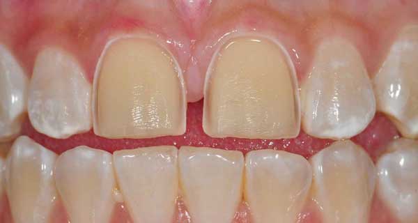 عوارض برداشتن کامپوزیت دندان 