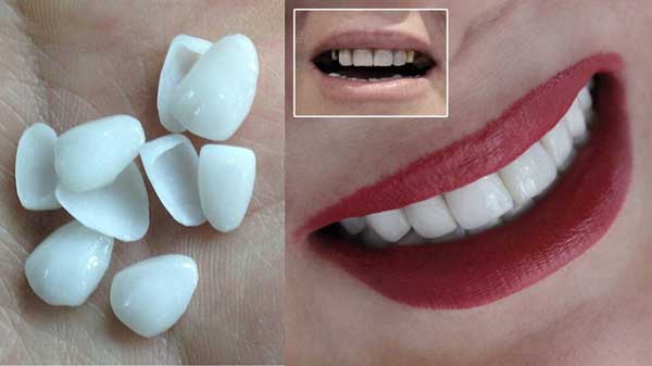 کامپوزیت دندان طبیعی تر است یا لمینت دندان؟