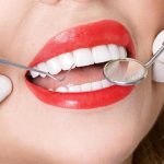مزیت لمینت برای دندان های کج