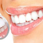 تفاوت لمینت و بلیچینگ