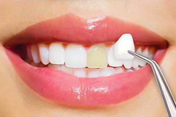 عوارض کامپوزیت دندان‌های جلو