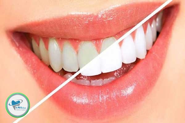 دلیل کنده شدن کامپوزیت دندان 