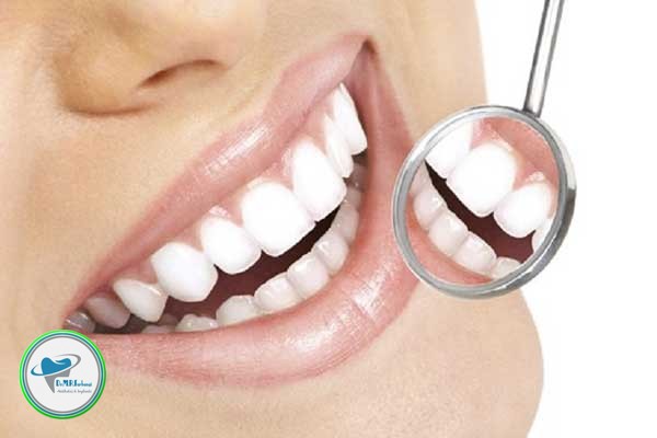دلیل کنده شدن کامپوزیت دندان 