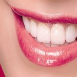 لمینت برلیانس چیست و چه مزایایی دارد؟