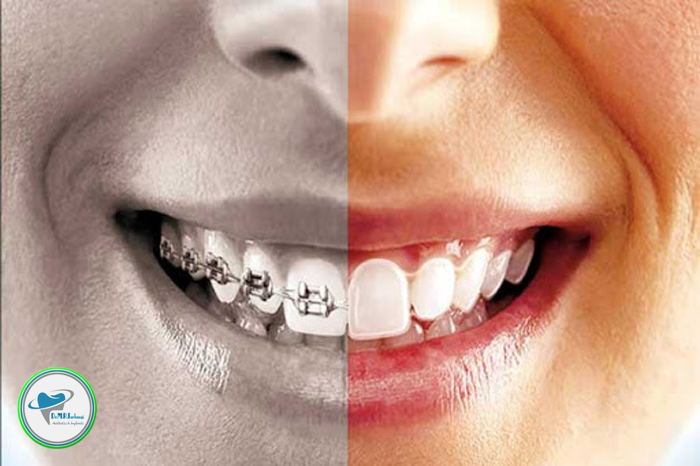 لمینت دندان چه تفاوتی با ارتودنسی با لیزر دارد؟