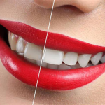 مزایای لمینت سرامیکی