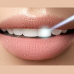 تفاوت لمینیت و روکش دندان چیست؟
