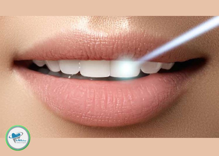 تفاوت لمینیت و روکش دندان چیست؟