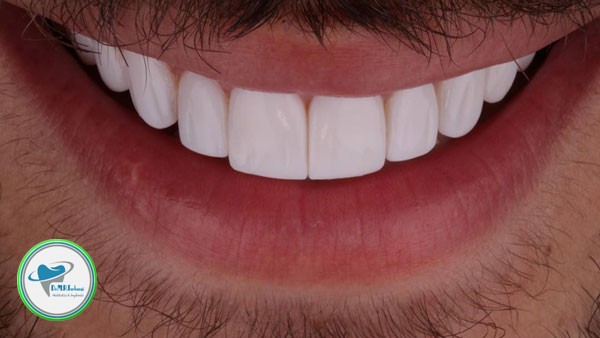 تفاوت لمینیت و روکش دندان چیست؟ 