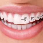 آیا می توان به جای ارتودنسی از لمینت برای دندان های کج استفاده کرد؟