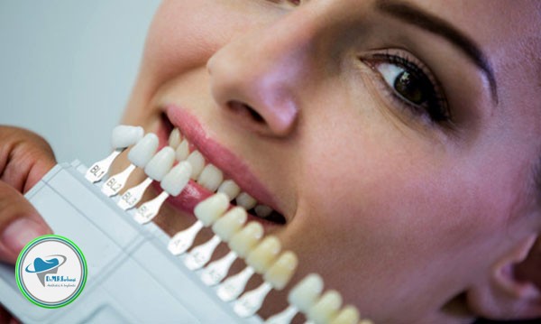 ماندگاری لمینت دندان چقدر است؟ 