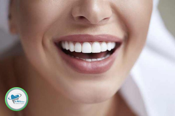 ماندگاری لمینت دندان چقدر است؟ 