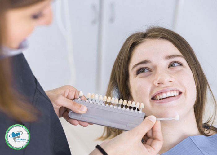 ماندگاری لمینت دندان چقدر است؟