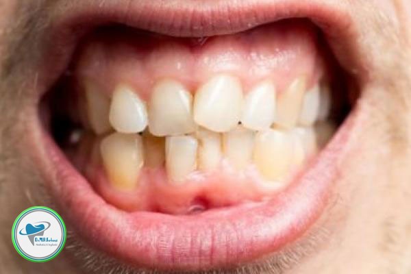 کامپوزیت دندان برای دندان های کج 