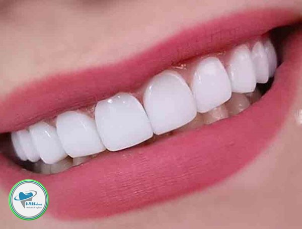 کامپوزیت دندان برای دندان های کج 