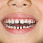 براى بستن فاصله بین دندانها چه راهکاری وجود دارد؟