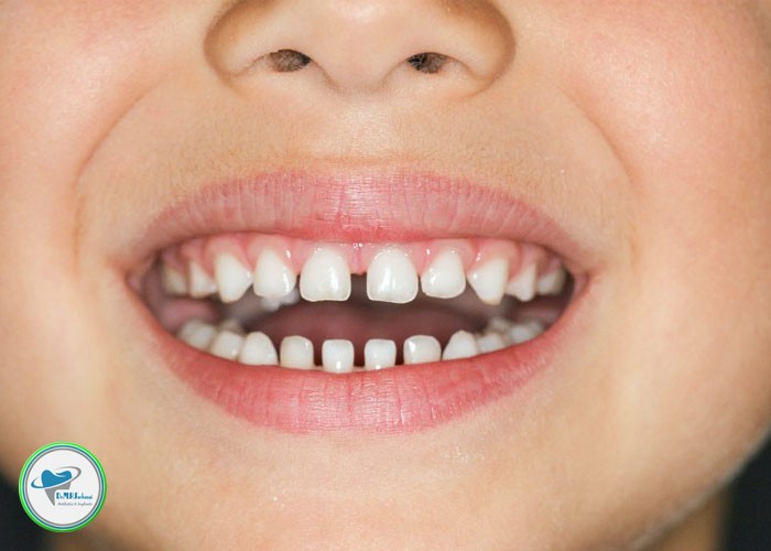 براى بستن فاصله بین دندانها چه راهکاری وجود دارد؟