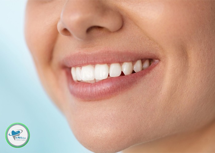 آیا لمینت دندان باعث بوی بد دهان می شود؟
