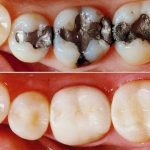 تعویض آمالگام با کامپوزیت