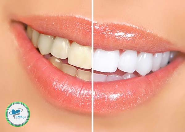 تفاوت های ایمپلنت و لمینت دندان 