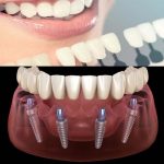 تفاوت های ایمپلنت و لمینت دندان