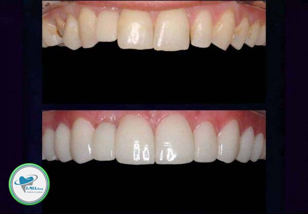 تفاوت های ایمپلنت و لمینت دندان 
