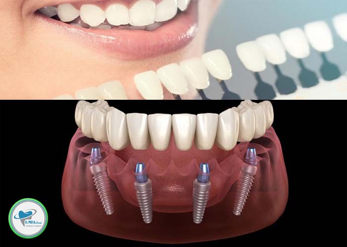 تفاوت های ایمپلنت و لمینت دندان