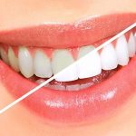 کامپوزیت دندان و بلیچینگ چه تفاوتی دارند؟