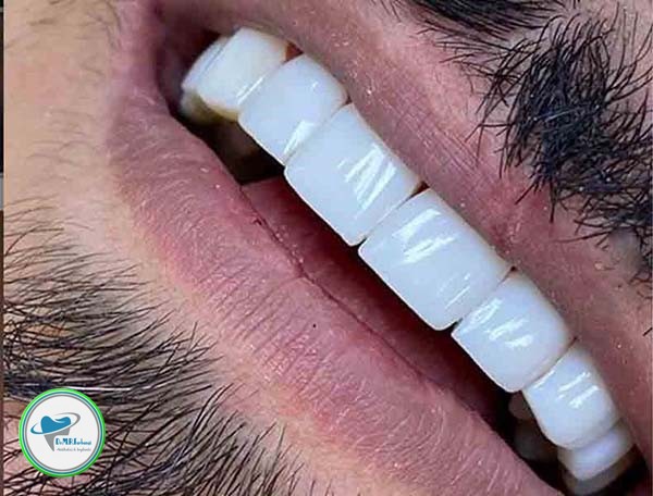 کامپوزیت دندان و بلیچینگ چه تفاوتی دارند؟ 